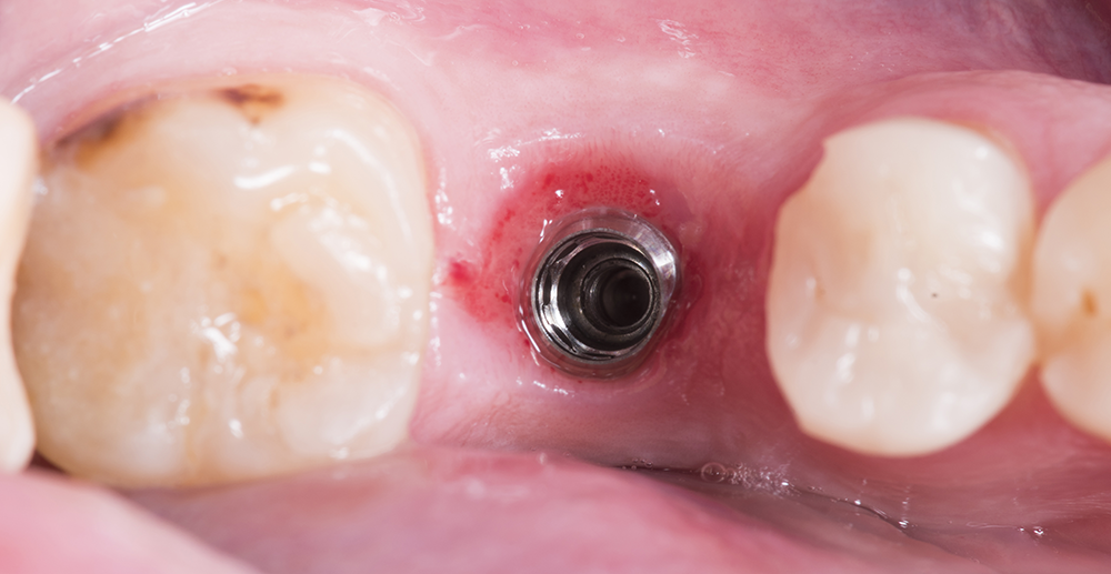 Implantes dentales